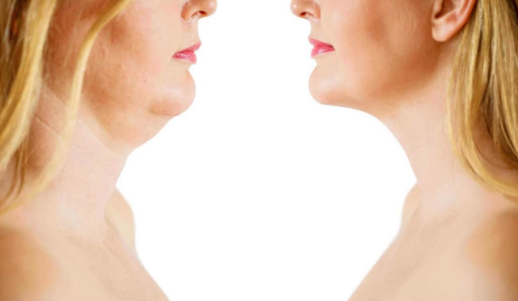 Double Chin treatment Binley before and after results