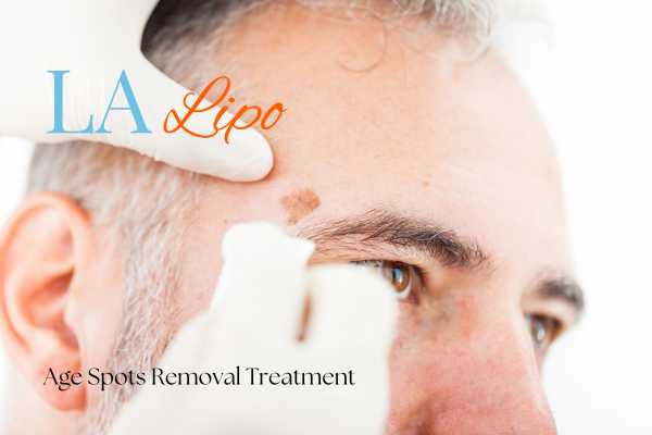 What Are the Most Effective Treatments for Age Spots Binley?