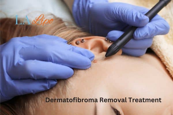 Dermatofibroma Removal Treatment Binley