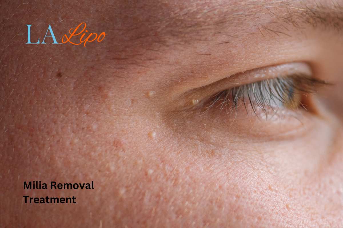 Cryopen Milia Removal: Is It the Easiest and Safest Option Binley?