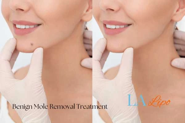woman's before and after mole removal Binley results