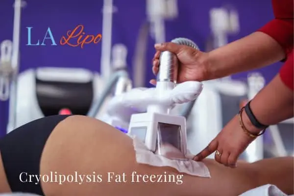 women getting fat freezing Binley