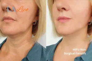 hi-fu for wrinkles Binley before and after results