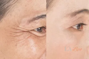 Before and after results of woman - HI-fu wrinkles reduction treatment Binley