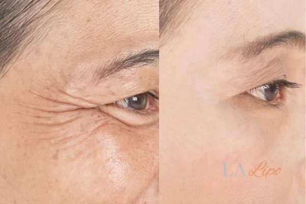 Before and after results of woman - HI-fu wrinkles reduction treatment Binley