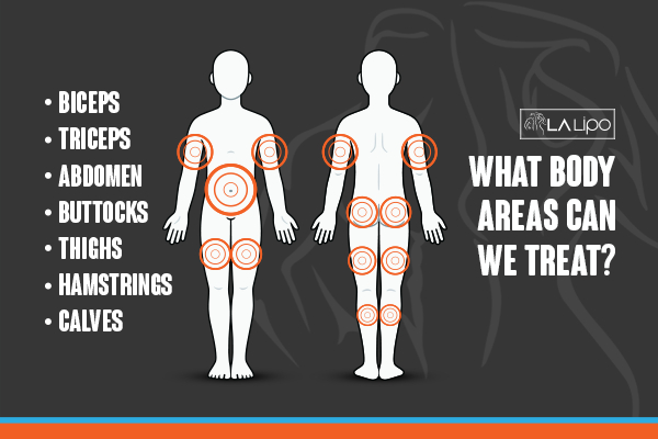 Graphic to show areas you can have LA-EMS Body Sculpting Binley treatment.