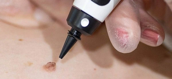 skin tag removal using cryopen Binley