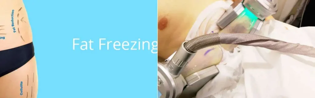 Fat freezing Binley on multiple areas of the body