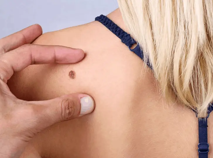 woman having mole removal Binley consultation before treatment.