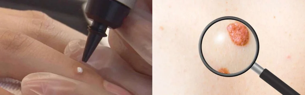 CryoPen practitioner Binley assessing a benign mole before treatment