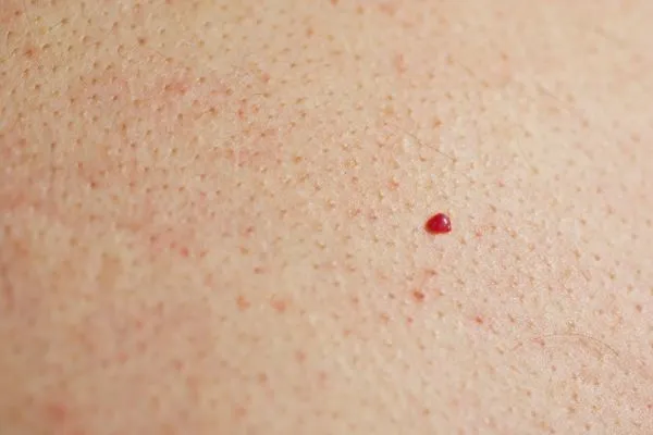 close up of a cherry angioma Binley