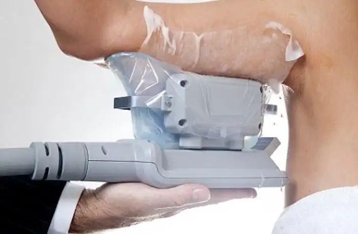Picture of fat freezing Binley on the upper arms.