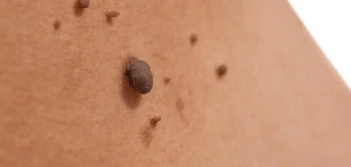 image of a skin tag Binley