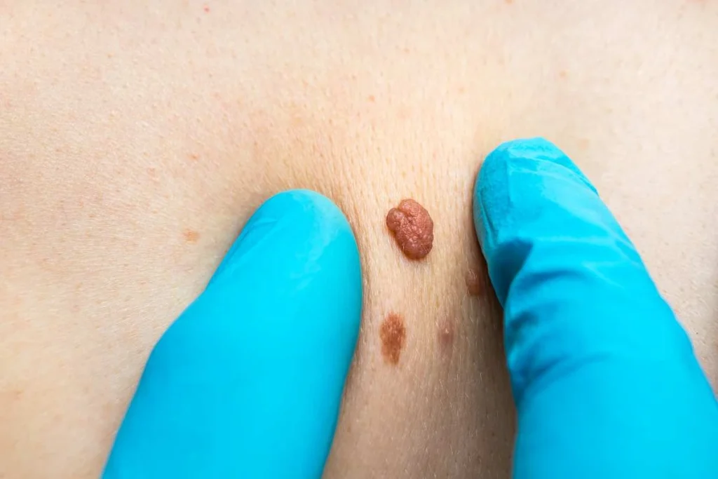 Consultant examining a skin tag Binley