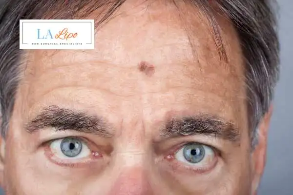 Solar Lentigo Removal Binley image of man with mark on his forehead