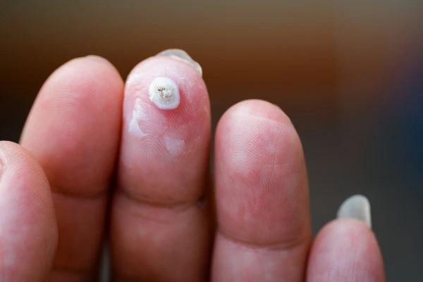 wart on person finger - cryotherapy to treat from LA LIPO Binley