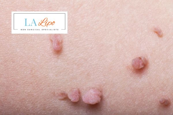 Does cryopen skin tag removal Binley hurt? Find out now call our team today!