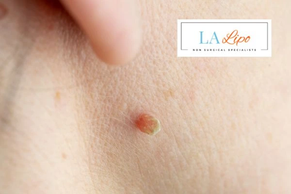 Book skin tag removal Binley today speak to our team now!