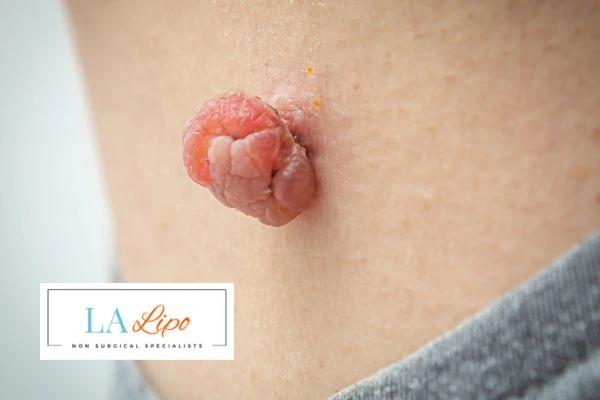 Interested in skin tag removal Binley? Concerned about the pain? Find out more today!