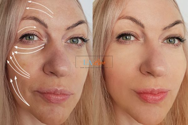 Morpheus 8 results Binley face lift.