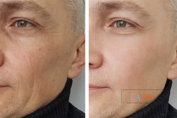 See the amazing results of Morpheus8 Treatment Binley!