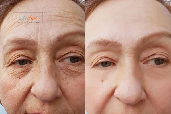 The powerful benefits of Morpheus8 Treatment Binley - Call Our team today!