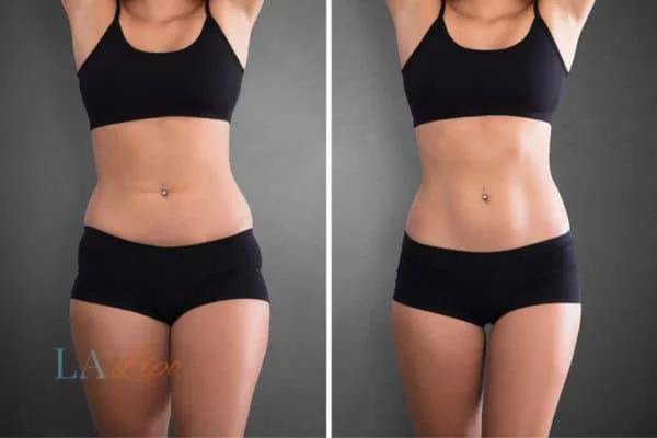 before and after results of non-surgical treatment to help a woman's body image and mental health Binley