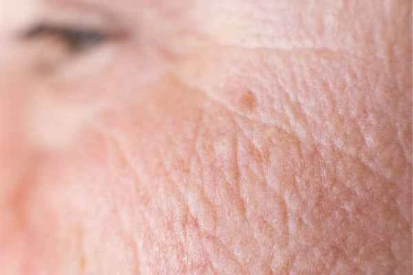 close up picture of a woman's face showing an age spot Binley
