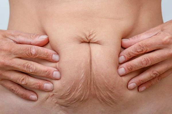 Image of a woman's stomach with loose skin - example of skin tightening Binley options