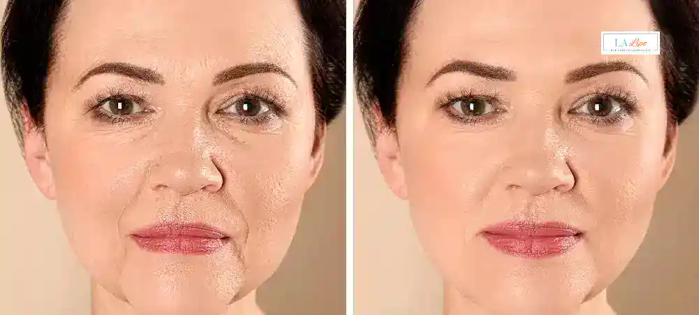 How Long Does It Take to See Results and How Long Do They Last Binley?