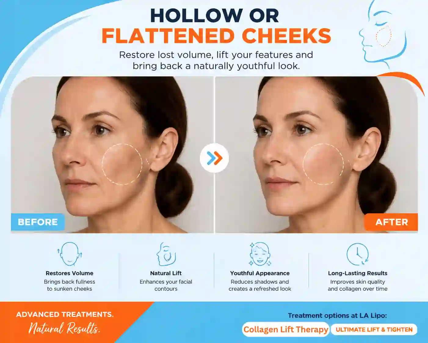 Sign #4: Hollow or Flattened Cheeks Binley