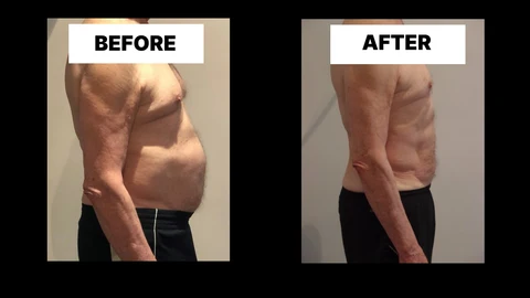 What Symptoms Can Diastasis Recti Cause in Men? Weak Core, Back Pain and Poor Posture Binley